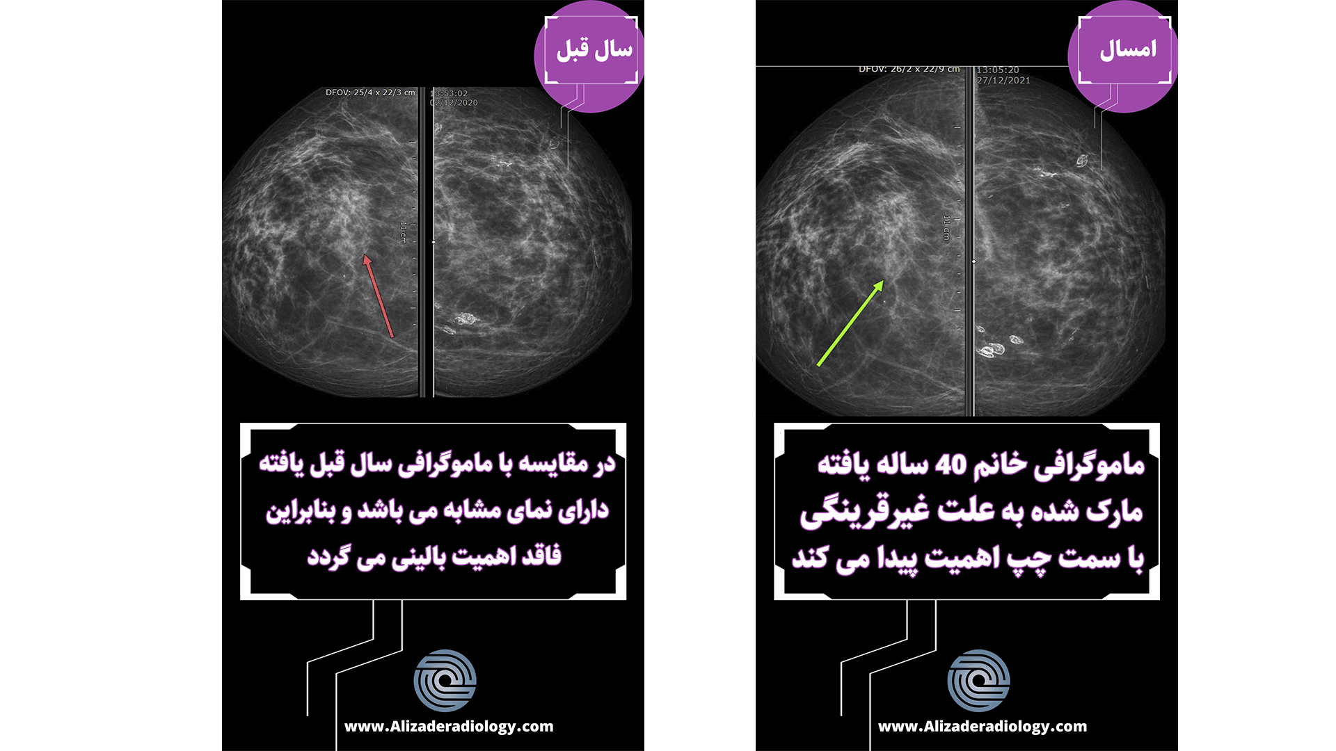 مقایسه ماموگرافی های سالیانه یک بیمار