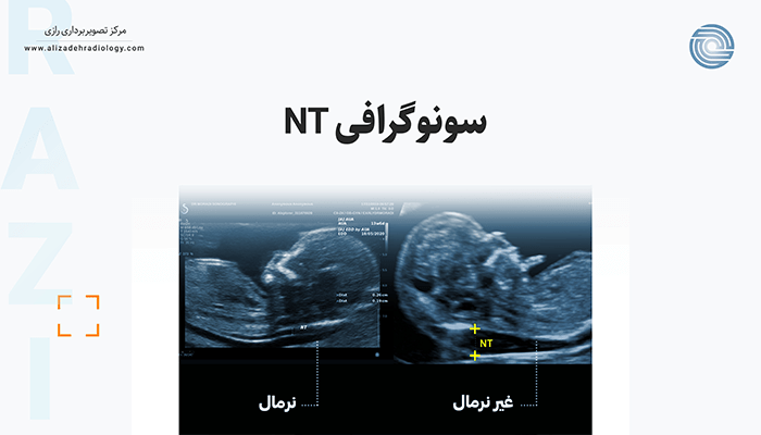 سونوگرافی NT چیست؟
